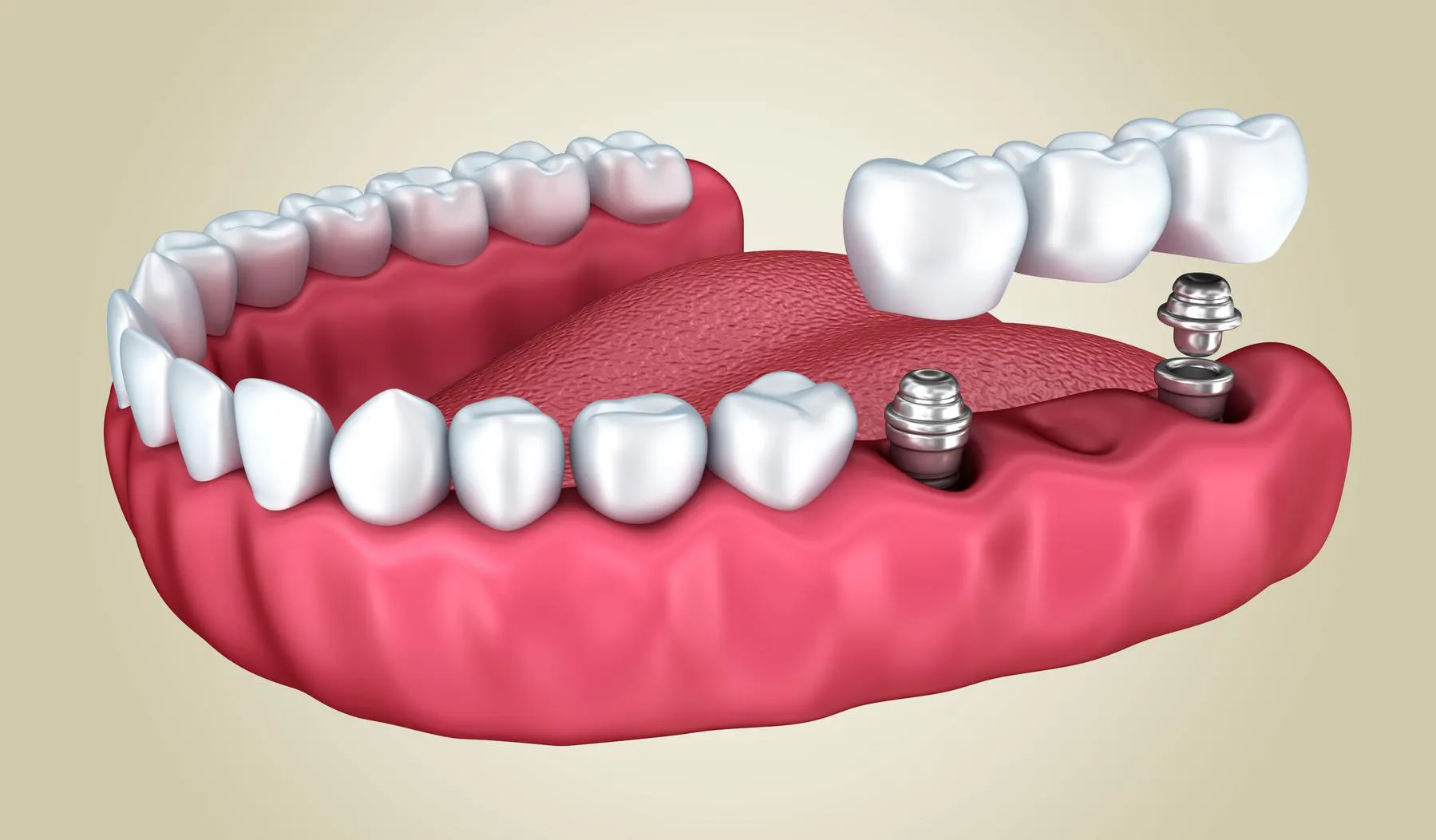 Dental Bridges