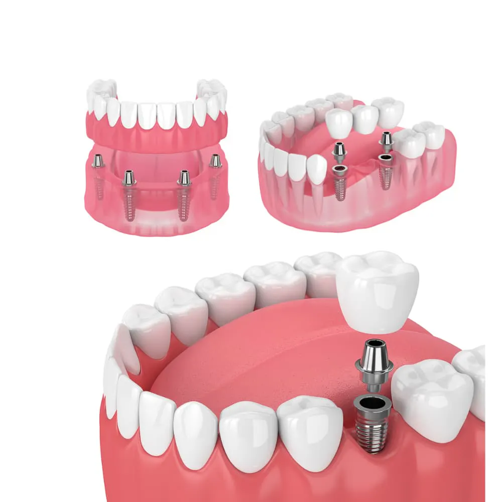 Implantatgetragener Zahnersatz.