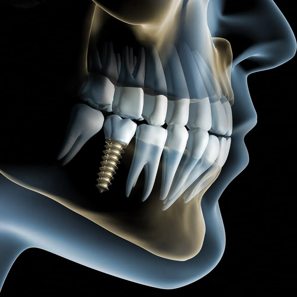 Digitale Implantatplanung am Bildschirm.