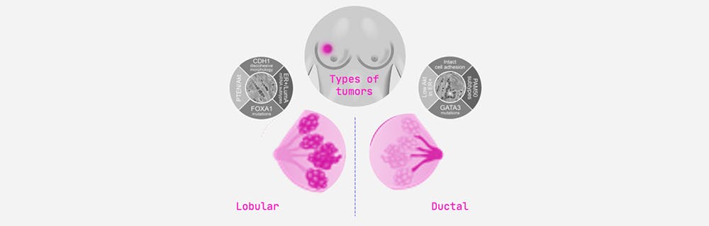 You can split breast cancer up in two categories: lobular and ductal.