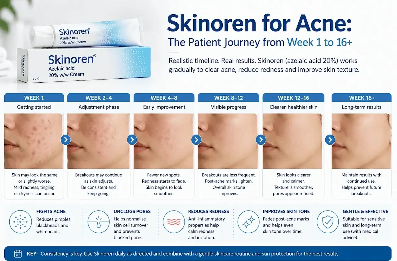 Skinoren acne treatment timeline infographic showing the patient journey from Week 1 to Week 16 and beyond, with reduced breakouts, fading redness and smoother, clearer skin at each stage
