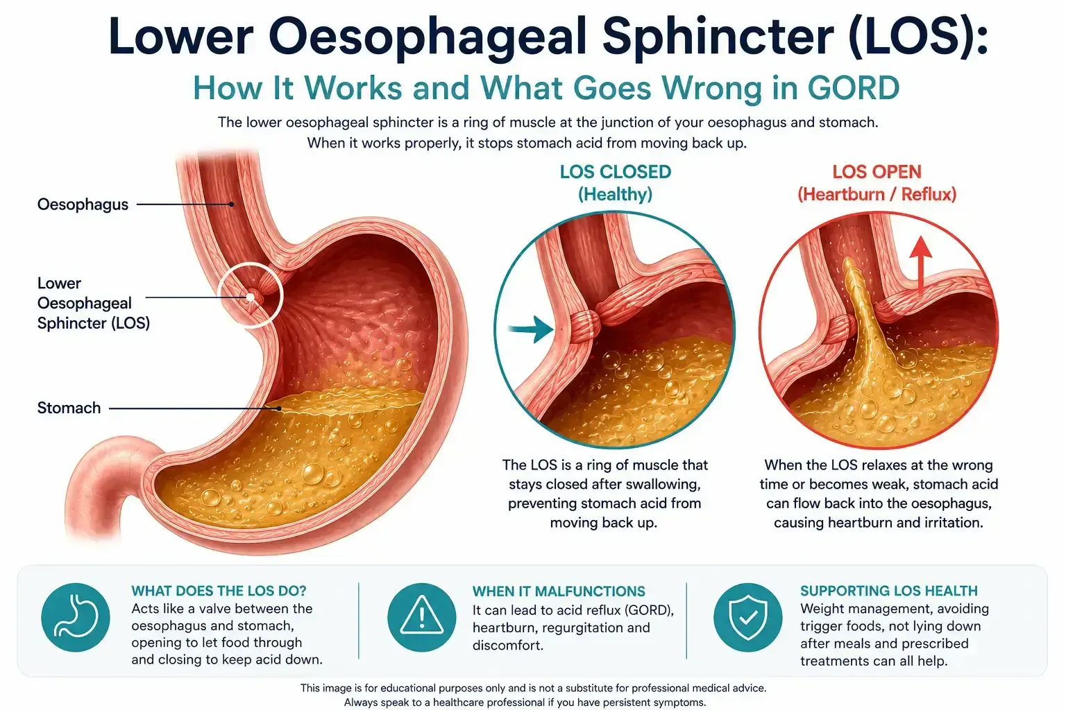 Diagram of the lower oesophageal sphincter (LOS): an anatomical view of the oesophagus and stomach, a close-up of the healthy closed valve keeping acid down, and a close-up of the open valve letting stomach acid reflux upward and cause heartburn in GORD