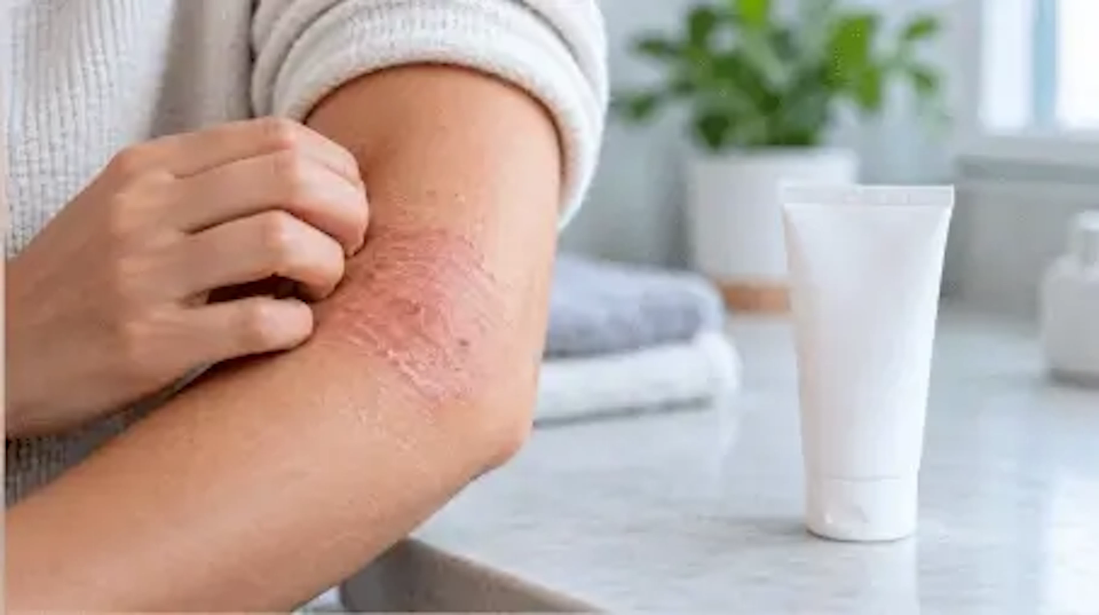 Steroid and Antibiotic Creams for Infected Eczema: Fucibet, Fucidin H, Trimovate and More