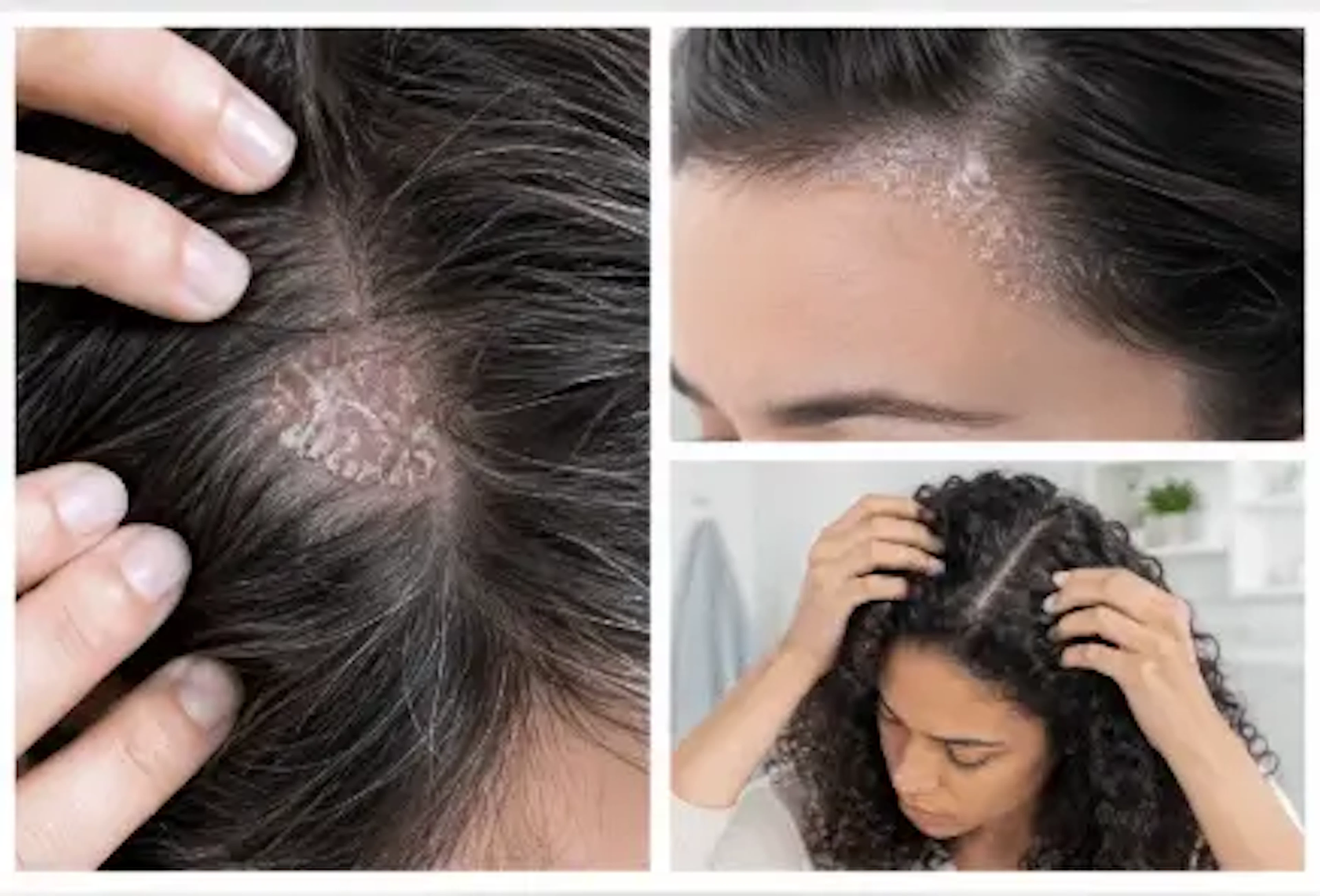 Psoriasis Shampoo: Which Shampoos Work for Scalp Psoriasis?
