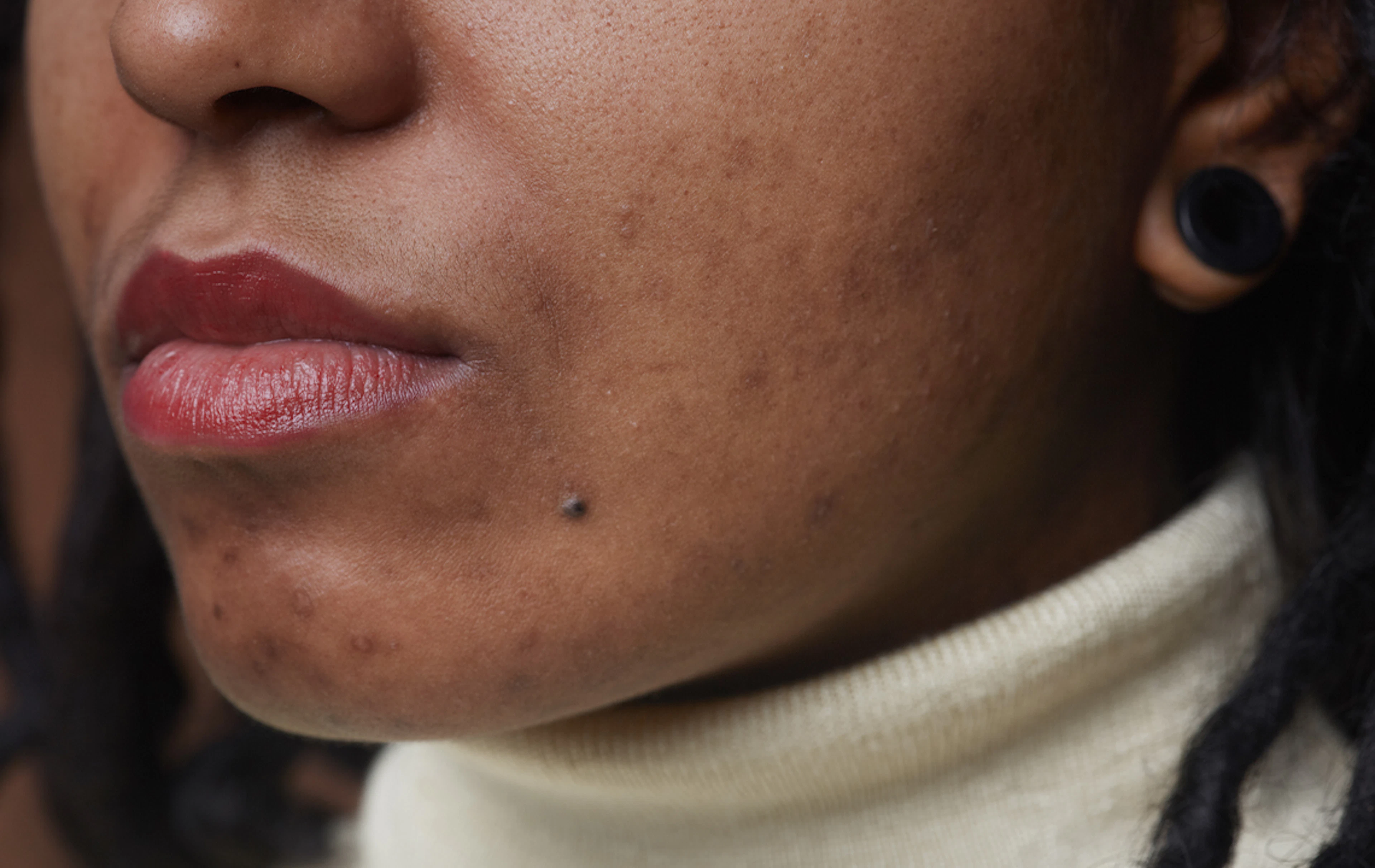 All you need to know about Acne