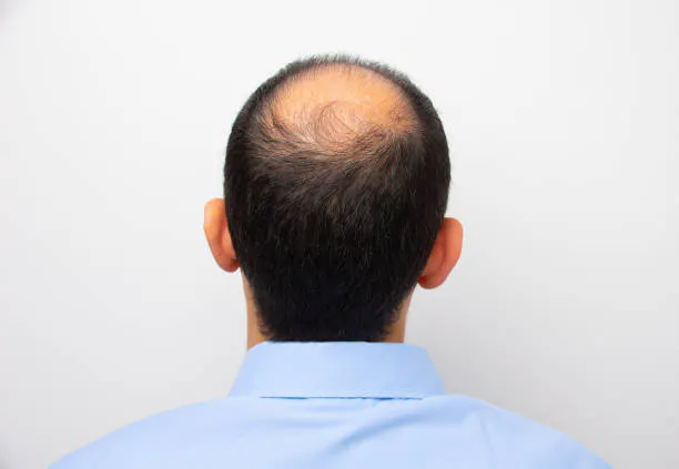 What is male pattern baldness?