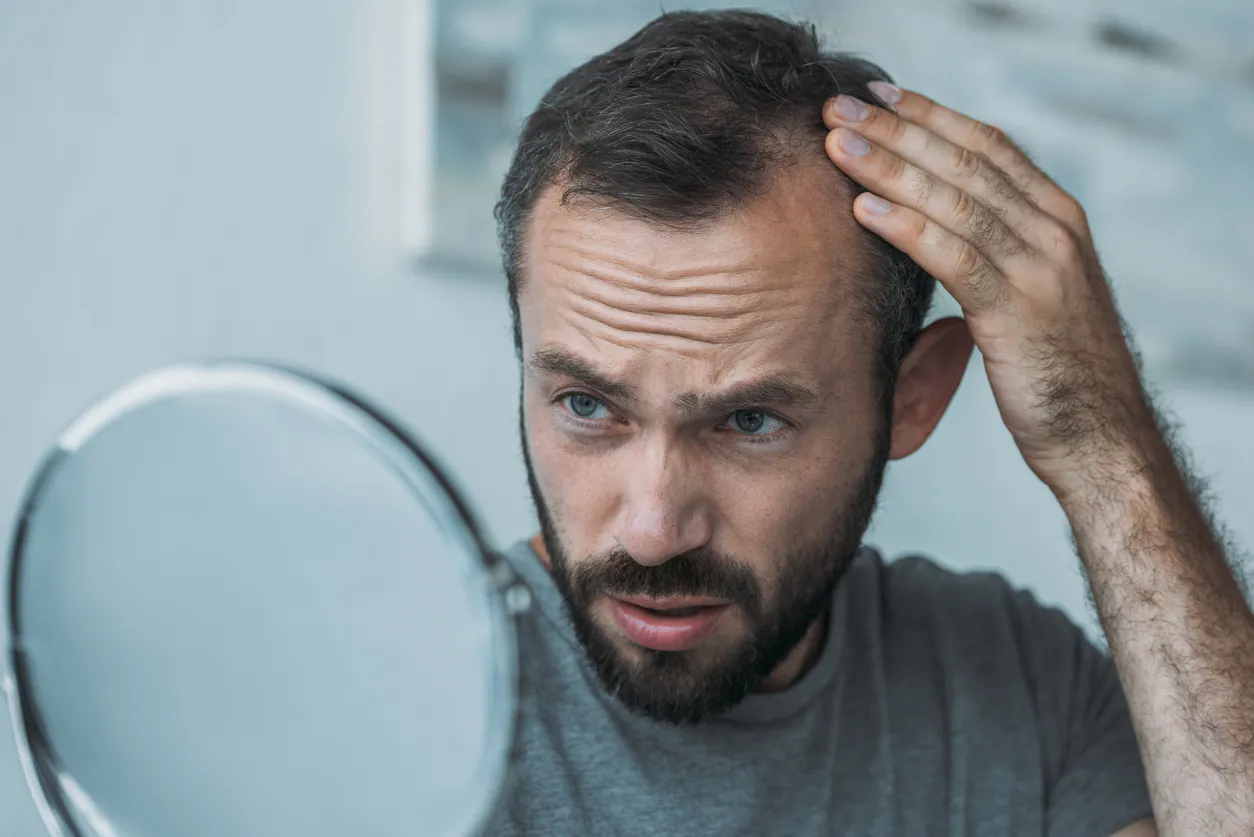Hair Loss in Men – What causes it ?