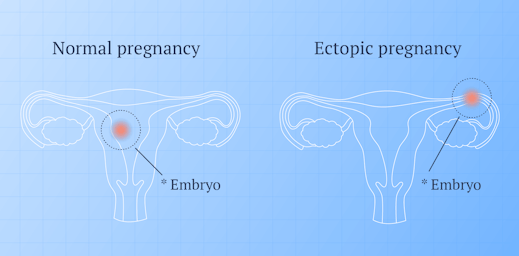 illustration of a regular pregnancy and a ectopic pregnancy