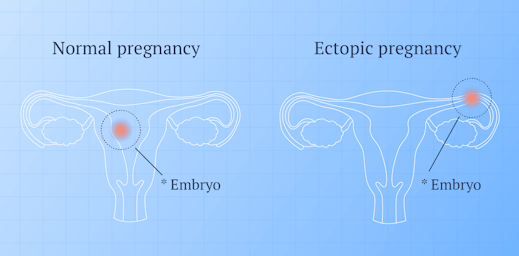 image of regular pregnancy and a ectopic pregnancy