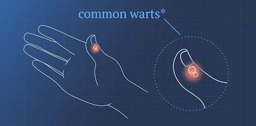 illustration of a hand with common warts on the thumb