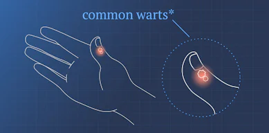 Common Warts Symptoms Causes Treatments Ada Health common-warts-symptoms-causes-treatments-ada-health