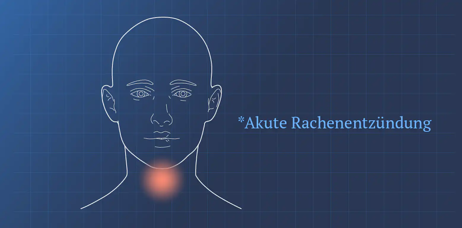 Akute Rachenentzündung - Symptome und Behandlung | Ada