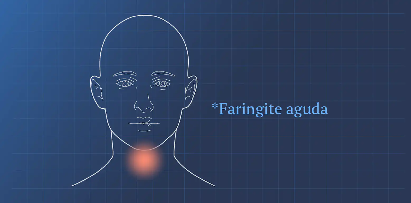 Faringite aguda | Sintomas | Viral | Bacteriana | Ada