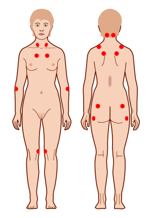 Tender points Aposentadoria por Fibromialgia - Advocacia Alves