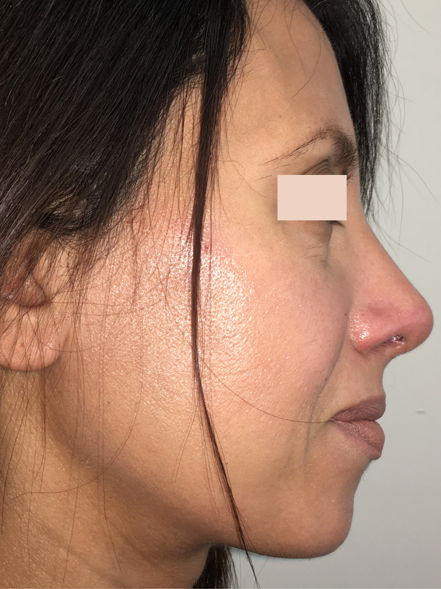 Rhinoplastie chirurgicale après