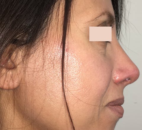 Rhinoplastie chirurgicale après