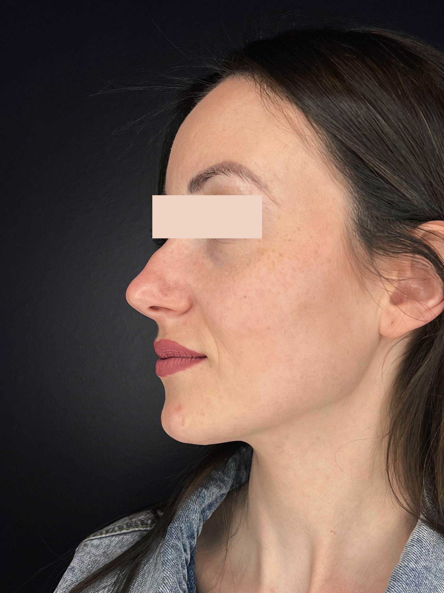 Avant Rhinoplastie médicale