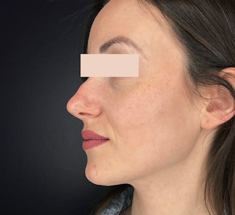 Avant rhinoplastie médicale par le Dr. Alexandre Mertens