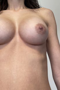 Resultat augmentation mammaire composite protheses avec lipofilling lyon docteur mertens