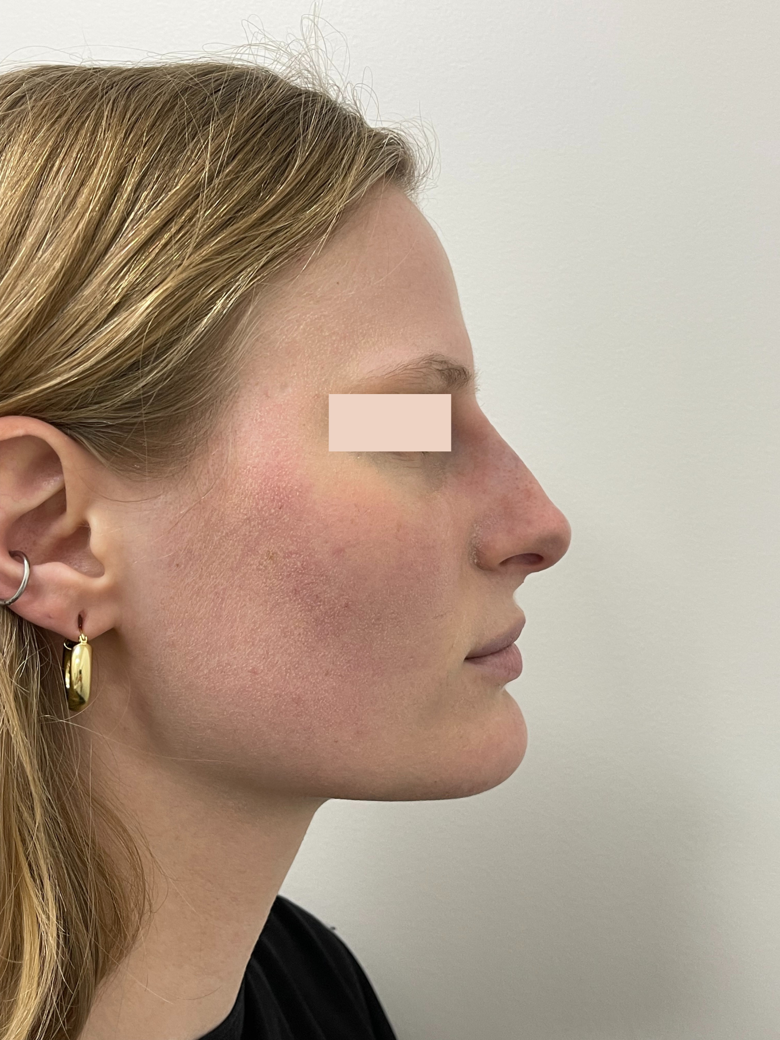 Après rhinoplastie médicale par le Dr. Alexandre Mertens