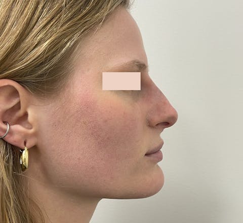 Après rhinoplastie médicale par le Dr. Alexandre Mertens