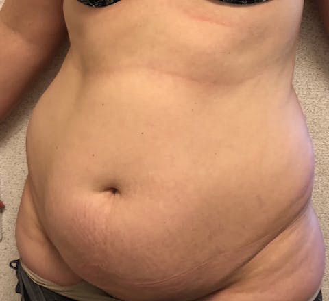 Abdominoplastie et lipoaspiration avant