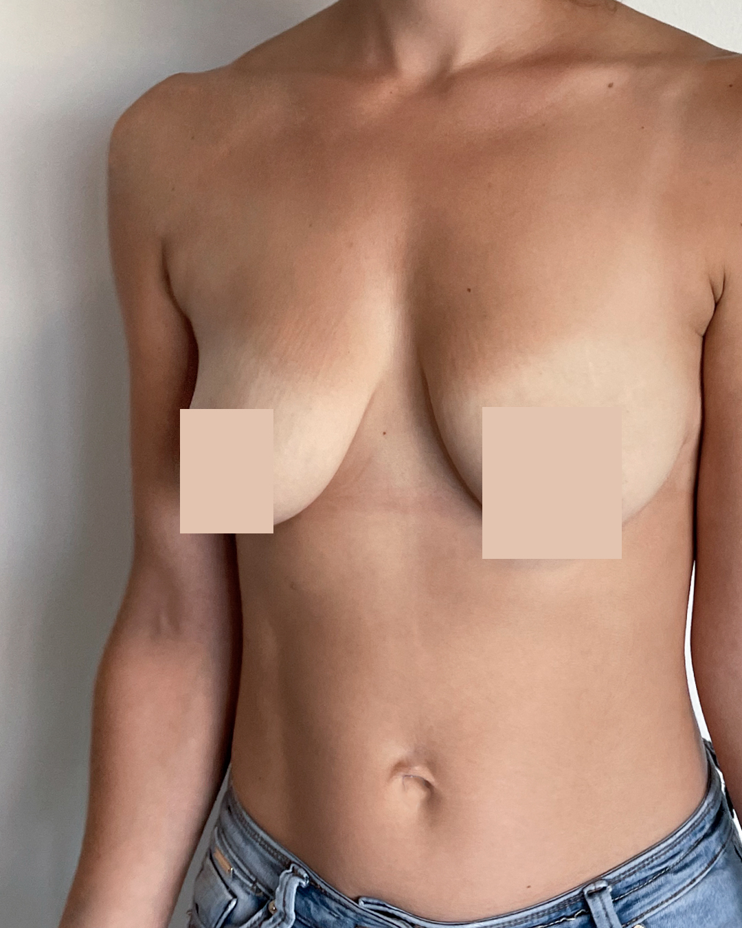 Combiner augmentation mammaire et lifting avant