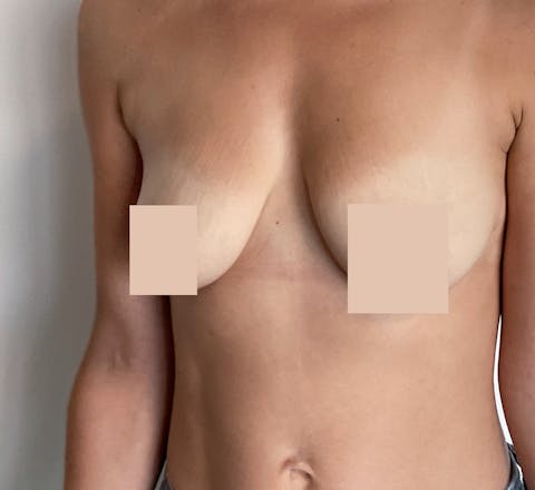 Combiner augmentation mammaire et lifting avant