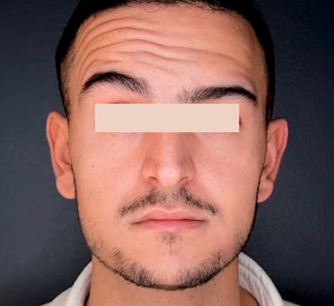 Avant Injections de toxine botulique