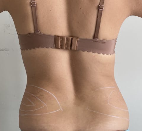 Cryolipolyse médicale avant