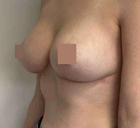 Malformations mammaires après