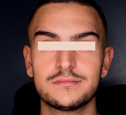 Après Injections de toxine botulique