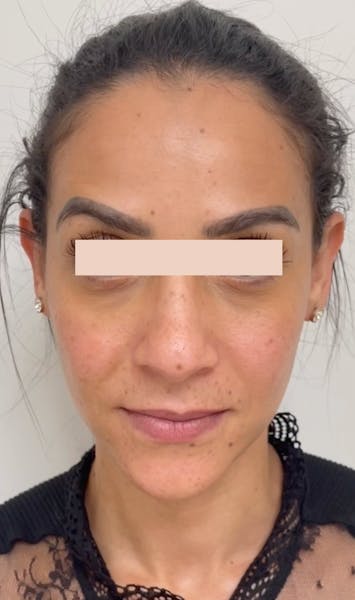 Injections de botox après