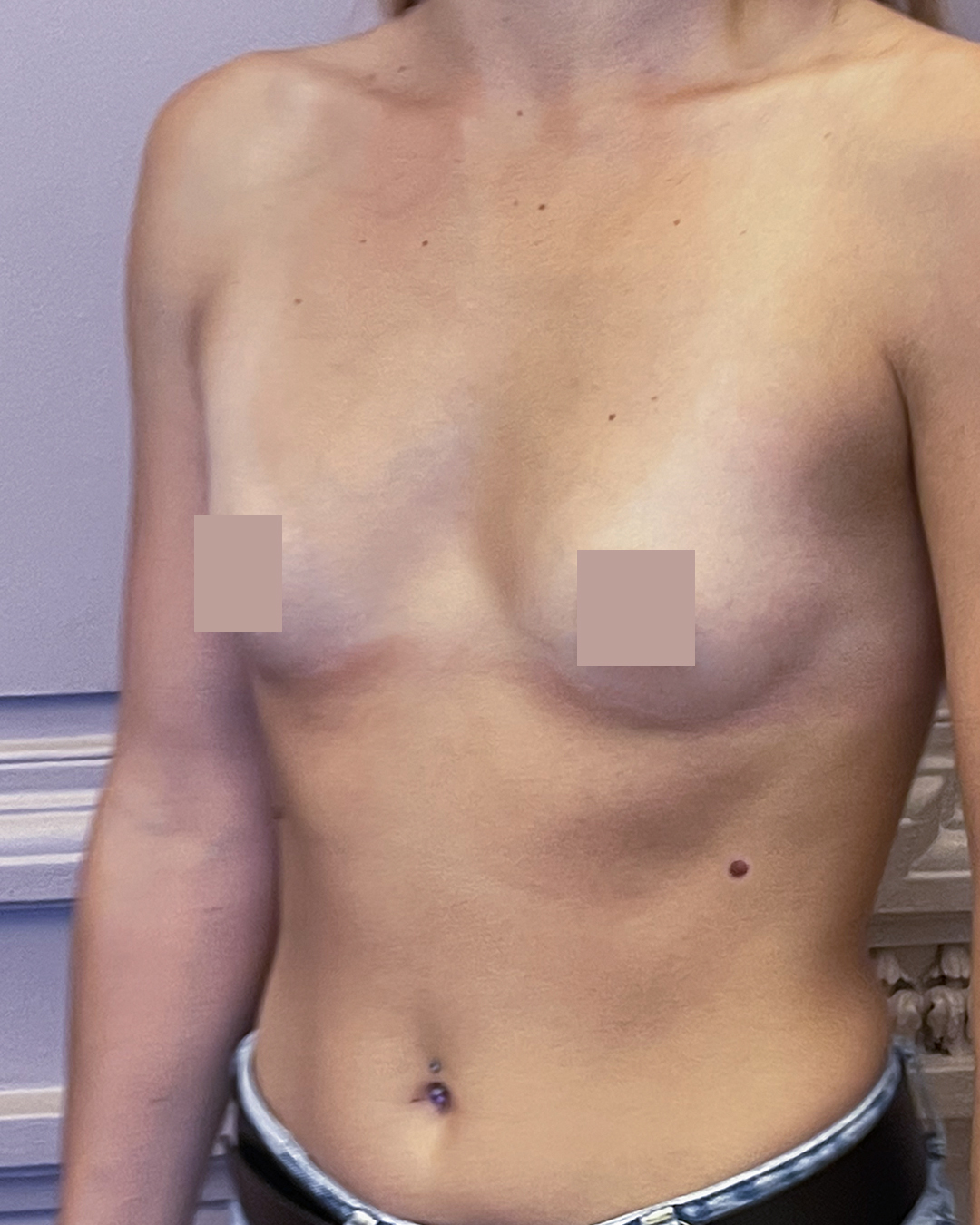 Avant augmentation mammaire