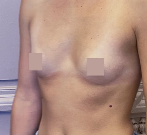 Avant augmentation mammaire