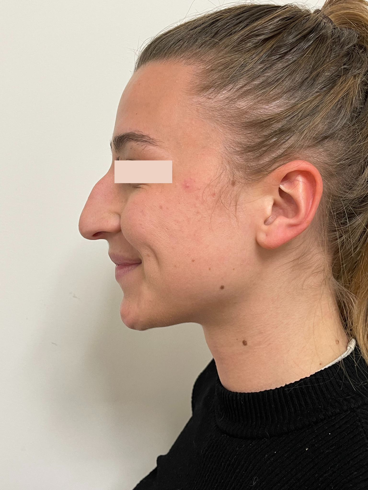 Avant Rhinoplastie primaire