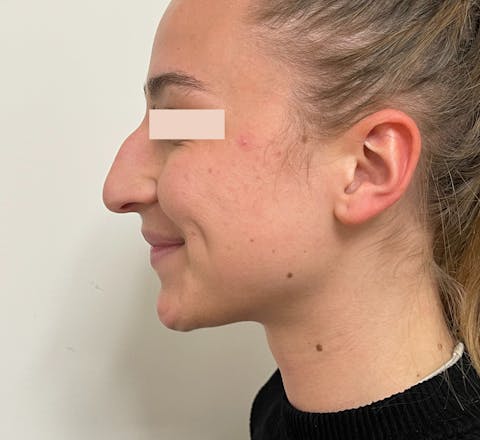 Avant Rhinoplastie primaire