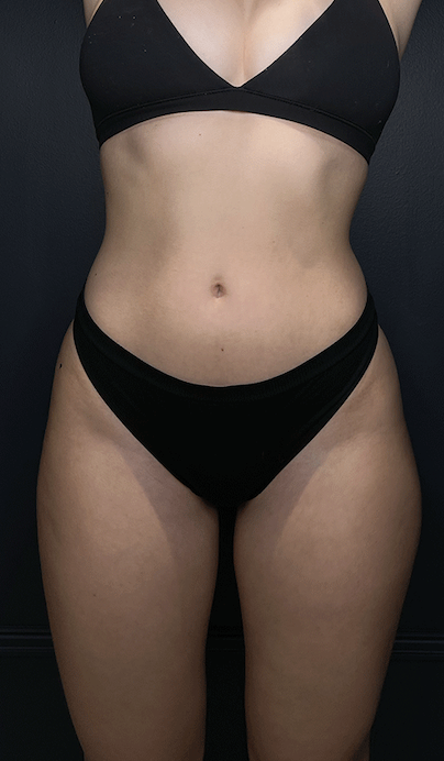 Avant Cryolipolyse médicale