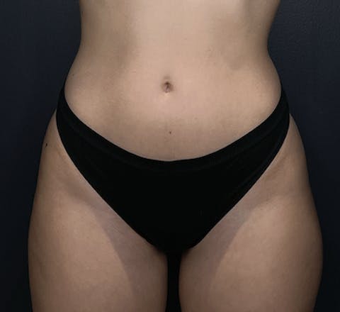 Avant Cryolipolyse médicale