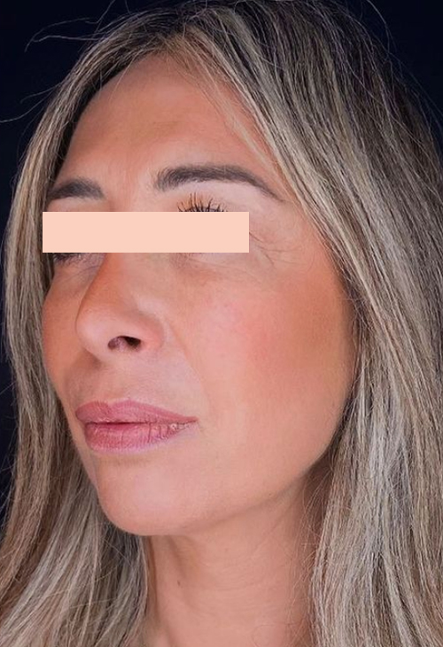 Lifting médical après