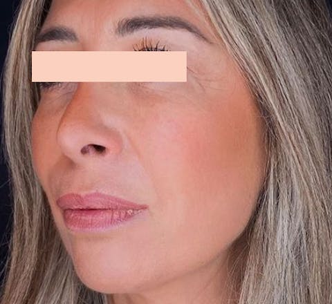 Lifting médical après