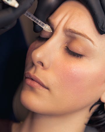 Injections de toxine botulique par le Dr. Alexandre Mertens