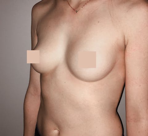 Chirurgie du sein avant