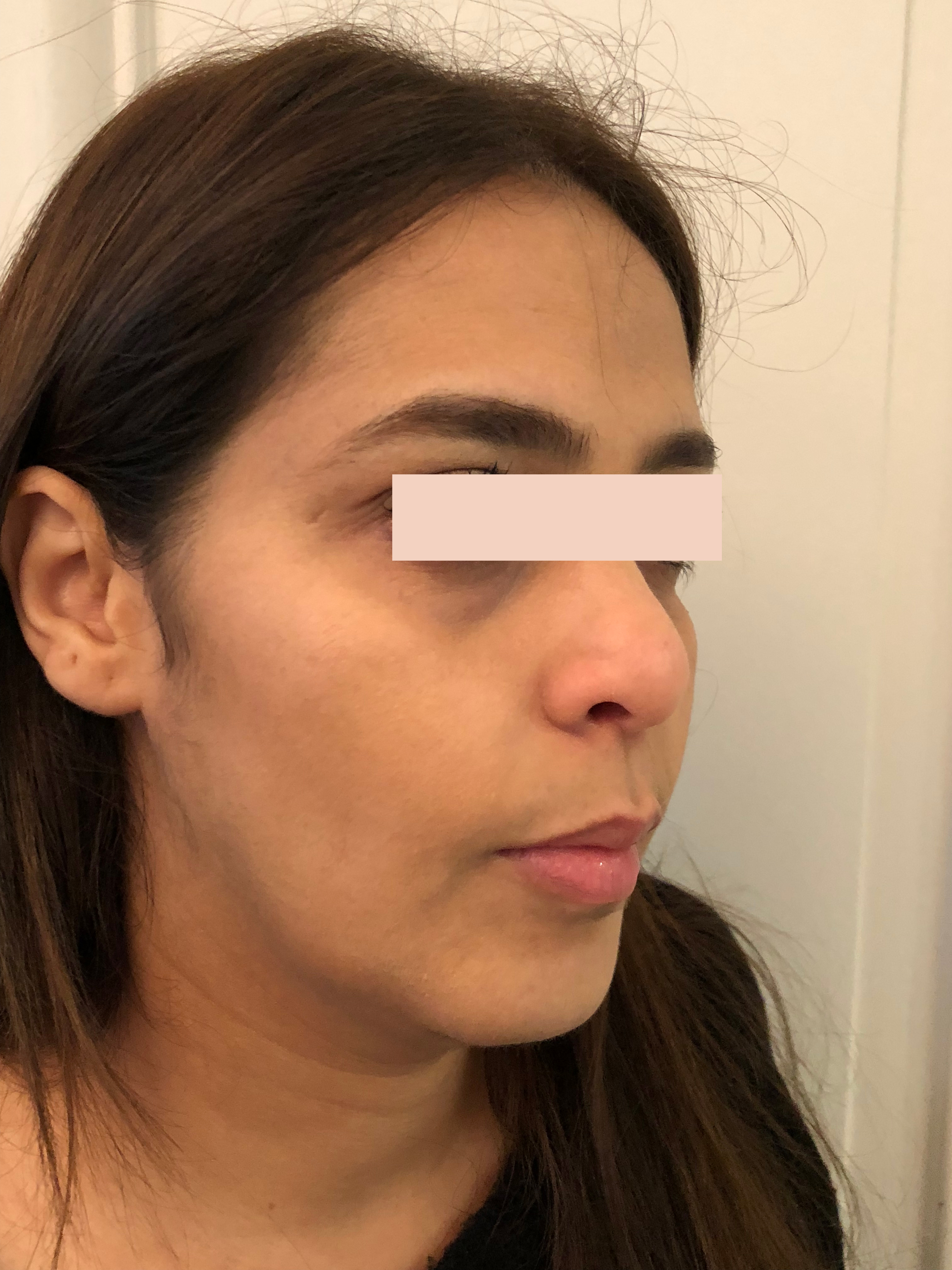 Avant Lifting médical par acide hyaluronique