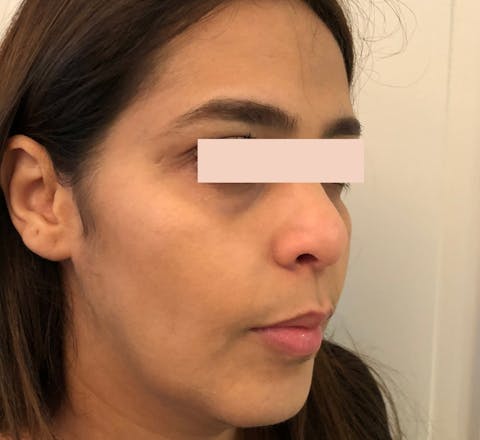 Avant Lifting médical par acide hyaluronique