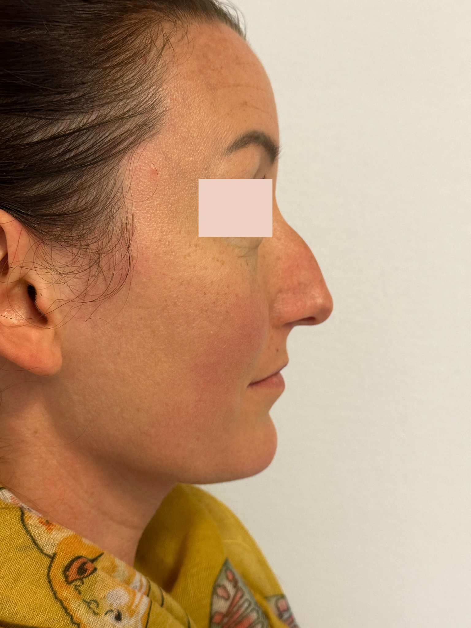 Avant Rhinoplastie primaire