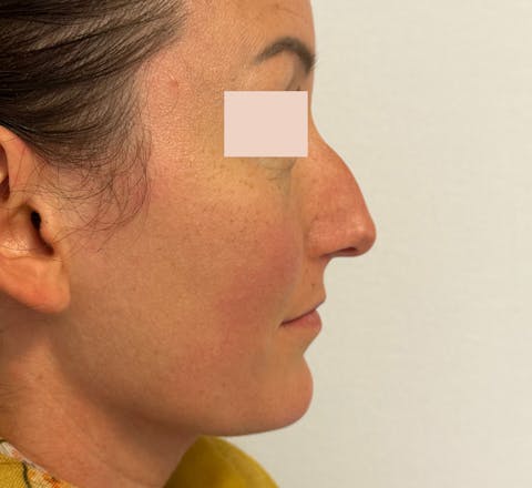 Rhinoplastie avant
