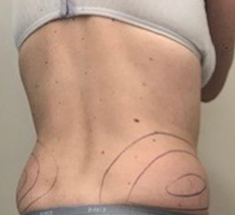 Cryolipolyse médicale du ventre avant