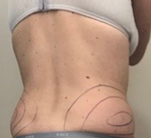 Cryolipolyse médicale du ventre avant