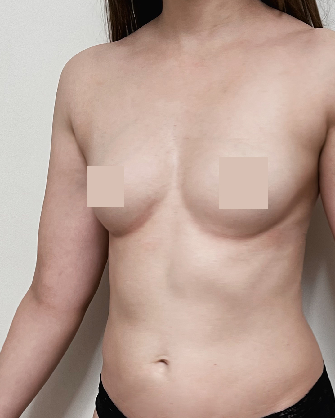 Avant augmentation mammaire